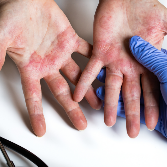 Hand Dermatitis caused by Chemical Accelerators